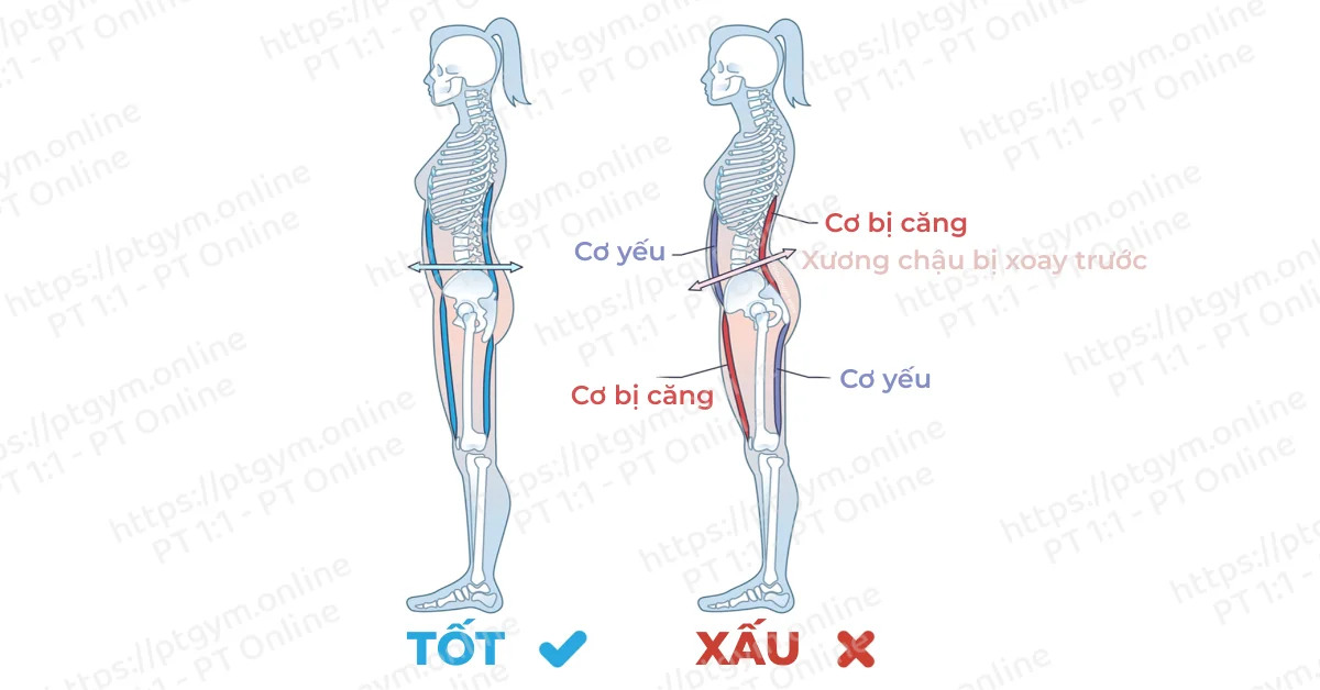 Cách khắc phục võng lưng