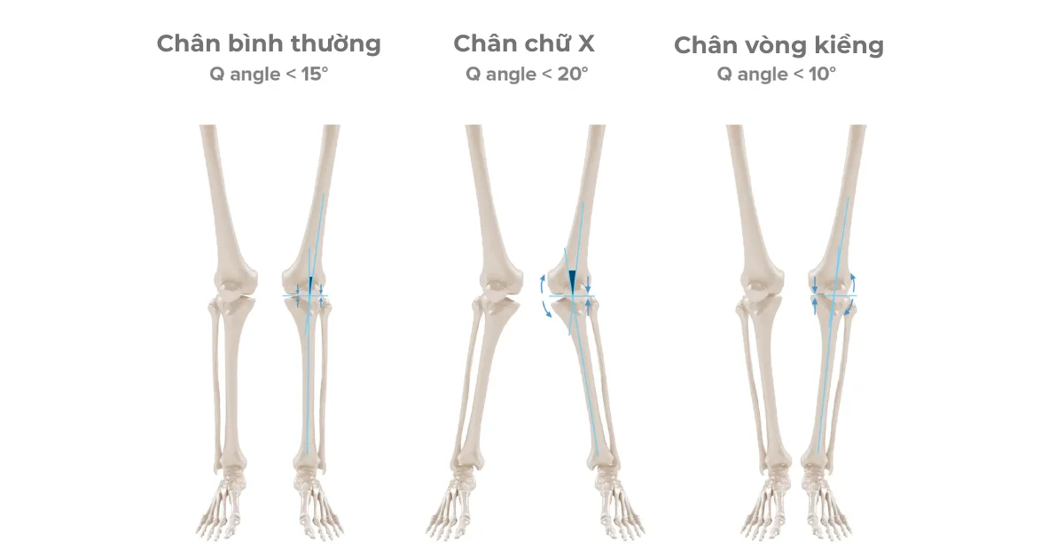 Dáng chân chữ X là gì?