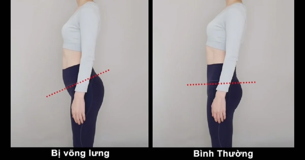 Võng lưng là gì?