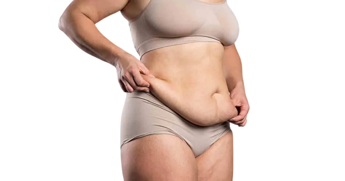 Bụng to do mỡ dưới da (subcutaneous fat)
