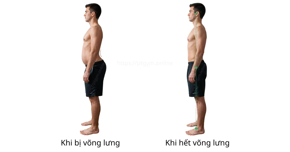 Tư thế võng lưng (Anterior Pelvic Tilt - APT)